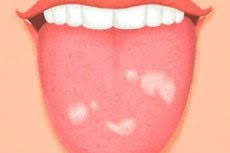 Sør for den store flekken smeltet i 2000 tre små flekker sammen til én hvit oval flekk (oval ba), halvparten så stor som den røde flekk. Hvite Flekker Pa Spraket Til Et Barn Og En Voksen Grunner Behandling Kompetent Om Helse Pa Ilive