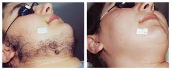 I've had botox, fillers and coolsculpting procedures done. Best Laser Hair Removal In Melbourne Dermacare Dermacare Cosmetic Laser And Skin Clinic Melbourne