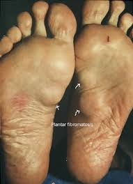 Spot that looks like a new mole, freckle, or age spot, but it looks different from the others on your skin. Tumors Of The Foot Causes And Treatment Options Myfootshop Com