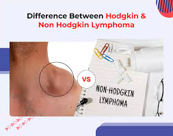 Image result for Lymphoma