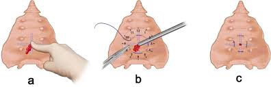 Image result for Purse String Suture