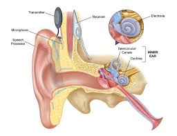 Image result for Cochlear Implant