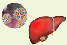 Hepatitis a hepatitis a disebabkan oleh infeksi virus hepatitis a. Hepatitis E Apa Itu Gejala Penghantaran Dan Bagaimana Rawatan Dilakukan Gejala 2021