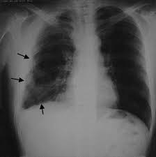 Space in the chest between the lungs (mediastinum) esophagus. Malignant Pleural Mesothelioma Metastasis To The Mandible Sciencedirect