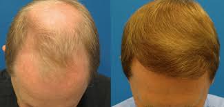 But vertex hair loss is not easily visible even with the mirror and it will be very well visible to others. Best Hair Clinics Hair Transplant Experts All Over Europe