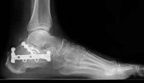 Image result for Calcaneus