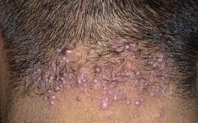 Pimples On Scalp Causes Small Painful Itchy Get Rid Treat Scalp Pimples Hair Loss Bumps Pimples On Scalp Neck Pimples Head Acne