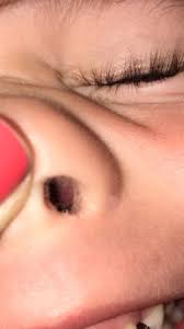 In addition, nasal polyps commonly develop in children with cystic fibrosis. Nasal Polyps Babycenter