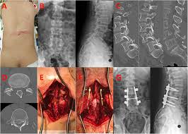 Check spelling or type a new query. Traumatic Bilateral L4 5 Facet Fracture Dislocation A Case Presentation With Mechanism Of Injury Bmc Musculoskeletal Disorders Full Text