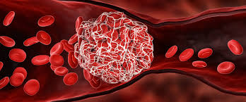 Qué debe saber sobre los coágulos de sangre y COVID-19