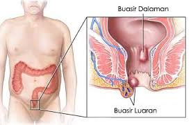 Dibutuhkan perhatian yang ekstra untuk merawat merpati, cek disini. Kementerian Kesihatan Malaysia Apa Itu Buasir Mengapa Buasir Terjadi Perlukah Saya Berjumpa Dengan Doktor Buasir Adalah Salur Darah Vena Yang Membesar Di Bahagian Bawah Rektum Dan Dubur Ia Akan Membawa Masalah