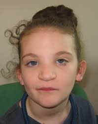 An epicanthic fold, epicanthal fold, or epicanthus is a skin fold of the upper eyelid, covering the inner corner (medial canthus) of the eye. Cdk13 Related Disorder Findzebra