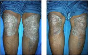Methotrexate Regulates Th 1 Response By Suppressing Caspase 1 And Cytokines In Psoriasis Patients Sciencedirect