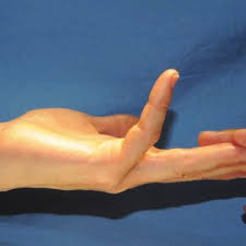 B absent fdp and variant insertion of the fds to the distal phalanx in a little finger on the right hand. Pdf Assessment Of The Presence Of Independent Flexor Digitorum Superficialis Function In The Small Fingers Of Professional String Players Is This An Example Of Natural Selection