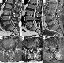 Image result for Spinal Epidural Abscess