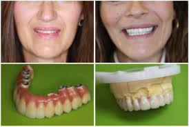 Pour vos soins dentaires à l'étranger, économisez jusqu'à 70 % sur vos soins dentaires en hongrie, helvetic clinics budapest. Prothese Sur Implant Hongrie Explications Avec Photos Et Videos