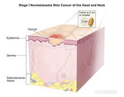 When found early, skin cancer can often be treated successfully. Skin Cancer Types Symptoms Information Dana Farber Cancer Institute Boston Ma