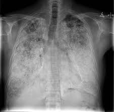Pulmonary Alveolar Microlithiasis Radiology Reference Article Radiopaedia Org Radiology Radiology Imaging Pulmonary