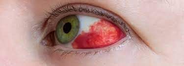 What causes blood vessels to burst. Broken Blood Vessels In The Eye Causes And Treatment