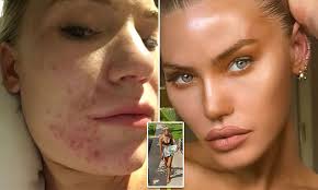 Model clears up her horrific acne with diet and meditation
