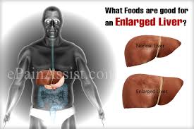 What Foods Are Good For An Enlarged Liver