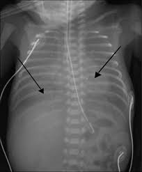 What good is the air bronchogram sign? Newborn Respiratory Disorders American Academy Of Pediatrics