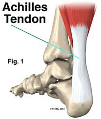 Maybe you would like to learn more about one of these? Achilles Tendon Rupture Morgan Hill Foot Pain Los Gatos Santa Clara County Ca