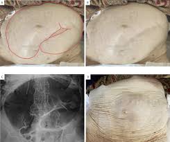 Image result for Sigmoid Volvulus