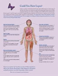 Yes Yes And About Three More Yes Es Sigh Could You Have Lupus Read This To Find The Symptoms Of Lupus Lupus Facts Diagnosing Lupus Lupus Diagnosis