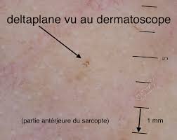 Parfum de gazoline sur les plages bétonnées. Dermato Info La Gale