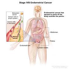 If you start spotting, even very slightly, call your doctor. Endometrial Cancer Treatment Pdq Patient Version National Cancer Institute
