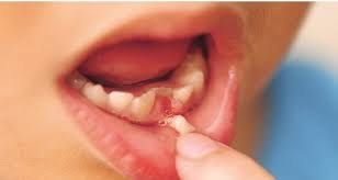 How to get a loose tooth out quickly. How To Get A Loose Tooth Out Arxiusarquitectura
