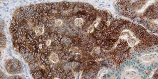 Early diagnosis and treatment how common is bowel cancer? Ai Could Improve Outcomes For Bowel Cancer Patients Healthcare In Europe Com