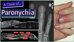 Image result for paronychium