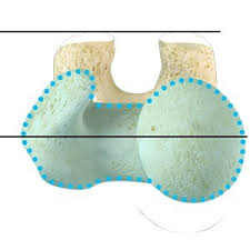 Image result for Femoral Retroversion