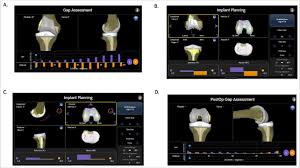 Image result for Patella Tracking Assessment