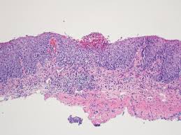 This guide is not intended to be used as a textbook. Pathology Outlines Eosinophilic Esophagitis