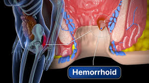 Image result for hemoroid human