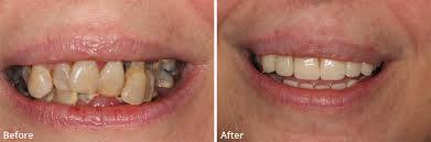 She then transitioned to a bonded bridge that attached to the backside of the adjacent without looking at the before picture, you wouldn't be able to tell which tooth is the dental implant. Partial Dentures Essex Quick Teeth Replacements Perfect Smile Spa