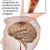Conoce todo sobre la trombosis, a través del dr. 1