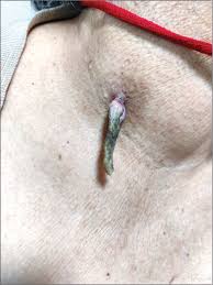 Image result for cornu cutaneum)