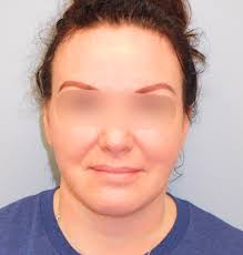 Plastic Surgery Photos