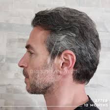 Pablo's Hair Transplant in Turkey: Before & After Results