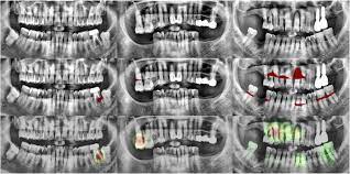 Digital imaging in dentistry / orth. Dentnet Deep Neural Transfer Network For The Detection Of Periodontal Bone Loss Using Panoramic Dental Radiographs Scientific Reports