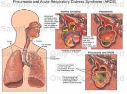 Abordul terapeutic al insuficientei respiratorii cronice, este diferit de cel al insuficientei respiratorii acute. Insuficienta Respiratorie Acuta