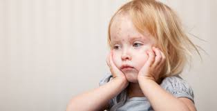 Chickenpox (Varicella) Vaccine Guide