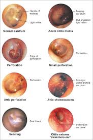 Eardrums Seen In 8 Conditions Normal Eardrum Acute Otitis Media Perforation Small Perforation Attic Perforat Otitis Media Otitis Health Assessment Nursing