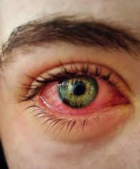 Red Bloodshot Eyes Or Red Eyes Aesthetic Eyes Bloodshot Eyes Crying Eyes