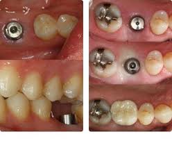 A Dental Implant Surgery Can Make You Smile Again And Allows You To Chew Your Favorite Food But To Have Succ Oral Surgeon Best Dental Implants Dental Implants