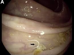Image result for Pinworm